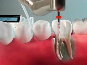 Секреты правильного лечения зубных каналов