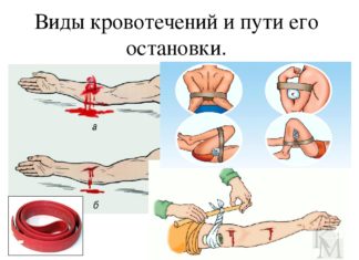 Кровотечения: виды и первая помощь при них