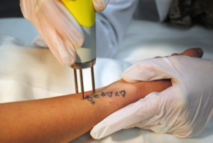 Как работает лазерное удаление татуировок?