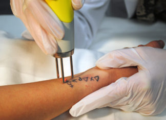 Как работает лазерное удаление татуировок?