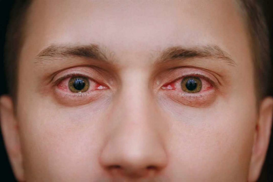 Фото человека с красными глазами