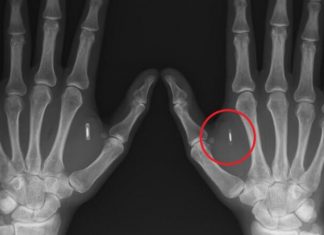 5 историй о том, как люди добровольно вживили себе чипы под кожу