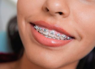 Брекеты: эффективный способ исправления прикуса и выравнивания зубов