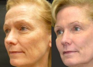 Ботокс: что это и для чего применяется?