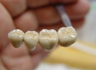 Коронки из металлокерамики: преимущества