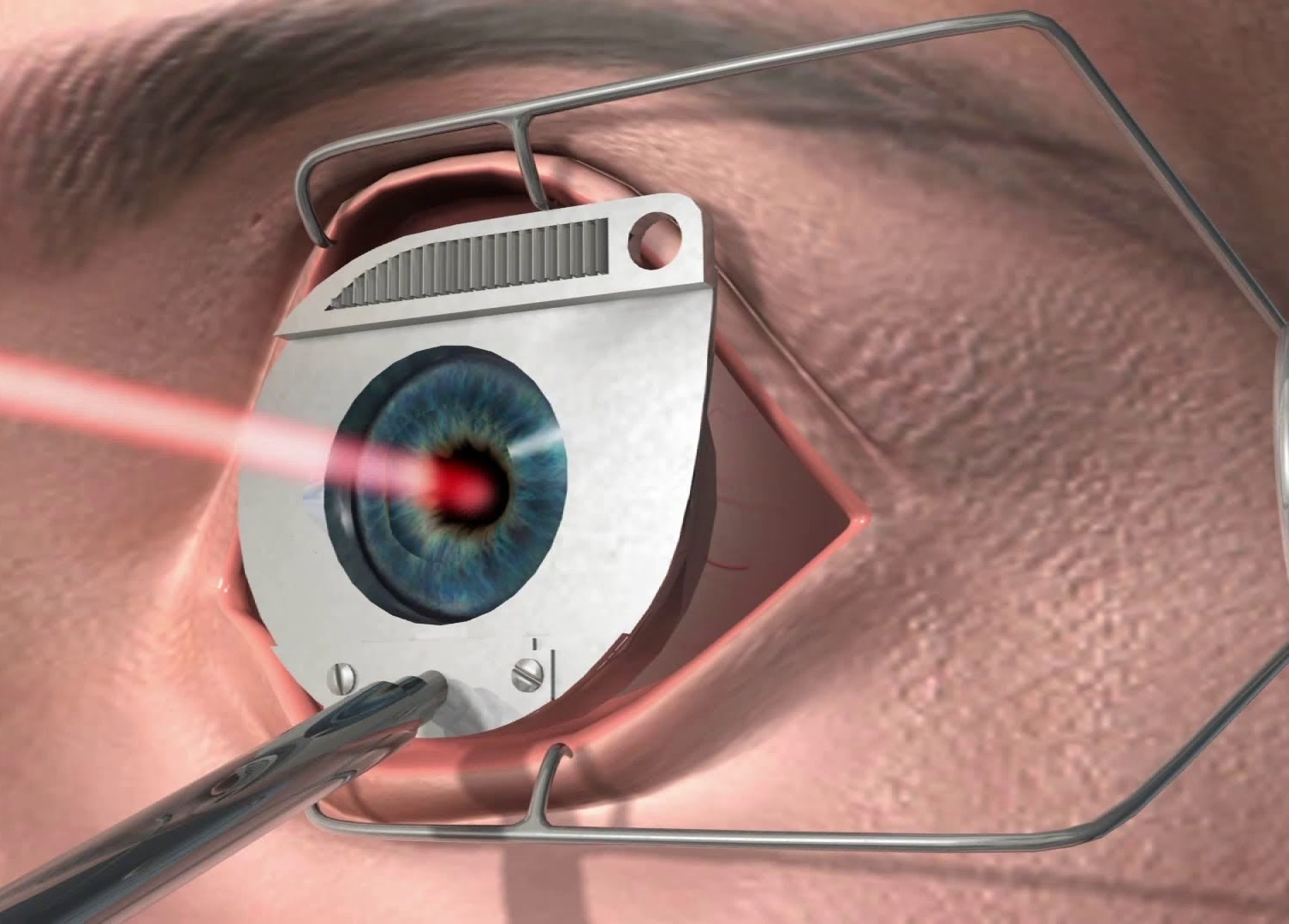 Лазерная коррекция зрения до какого возраста. Фемто ласик. ФРК ласик. Лазерная операция на глаза.