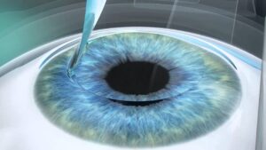 Популярные методы лазерной коррекции зрения