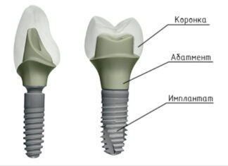 Виды и особенности производства абатментов