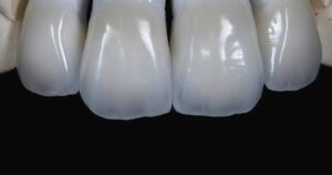 Дисиликат лития в стоматологии: что это и как правильно используется