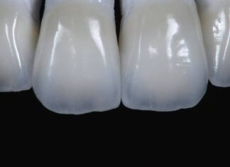 Дисиликат лития в стоматологии: что это и как правильно используется