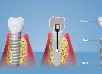 Одномоментная имплантация зубов: плюсы и минусы, особенности