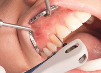 Лечение десен- когда и какие методы предлагают стоматологи