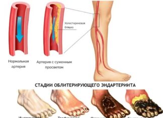 Причины и рекомендации по лечению облитерирующем эндартериите конечностей