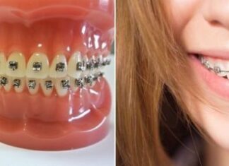 Преимущества и установка брекетов Mini Diamond