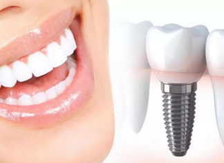 Способы и преимущества имплантации зубов