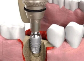 Советы по имплантации зубов и возможности стоматологии