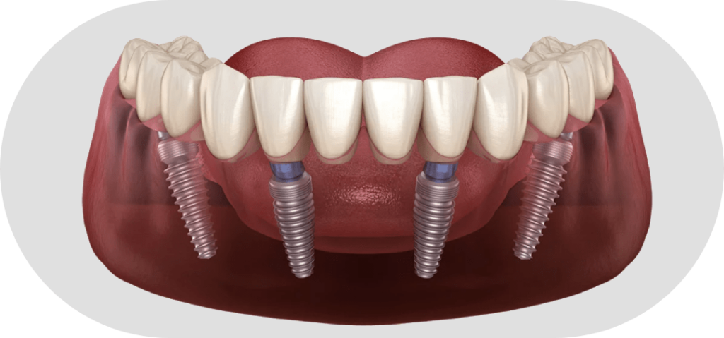 Имплантация Всё на четерых – как и когда проводится в стоматологии