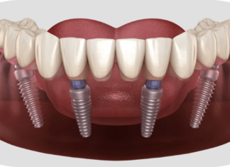 Имплантация Всё на четерых – как и когда проводится в стоматологии