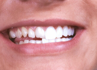 Почему и когда устанавливают зубные виниры