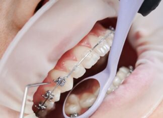 Процесс установки брекетов: всё, что нужно знать заранее