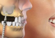 Синус-лифтинг: ваш шанс на здоровые зубы даже при недостатке костной ткани