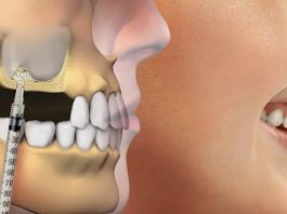 Синус-лифтинг: ваш шанс на здоровые зубы даже при недостатке костной ткани