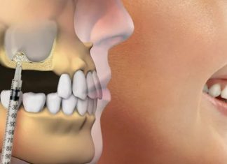 Синус-лифтинг: ваш шанс на здоровые зубы даже при недостатке костной ткани