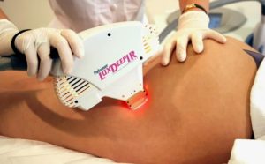 Лазерная шлифовка растяжек: эффективное решение проблемы несовершенств кожи