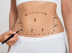 Абдоминопластика живота: что это такое и как проходит операция