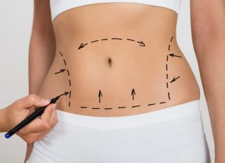 Абдоминопластика живота: что это такое и как проходит операция
